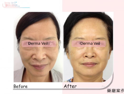Derma Veil 中臉整體改善臨床案例分享