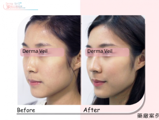 Derma Veil 面側輪廓與膚質改善臨床案例分享