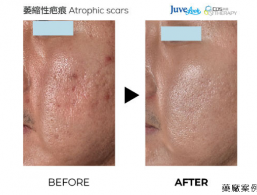 Juvelook 萎縮性疤痕修復臨床案例分享