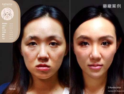  ELLANSÉ M面部結構治療臨床案例分享